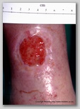 leg ulcer