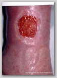 leg ulcer