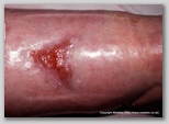 leg ulcer