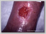 leg ulcer