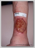 leg ulcer