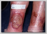 leg ulcer