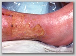 leg ulcer