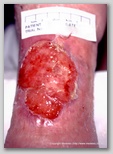 leg ulcer