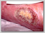 leg ulcer