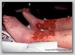 leg ulcer