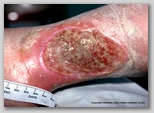 leg ulcer