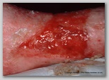 leg ulcer