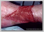 leg ulcer