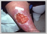 leg ulcer