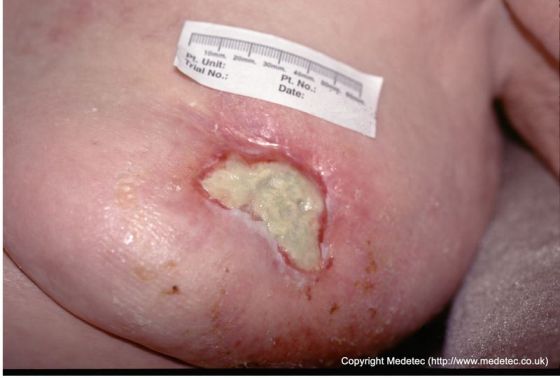 Sloughy wound formed following treatment for breast cancer