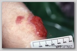 wound image