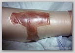 wound image