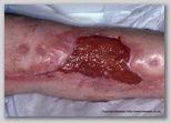 wound image