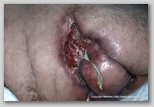 wound image