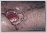 wound image