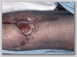 wound image