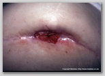 wound image