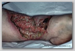 wound image