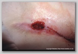 wound image