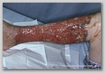 wound image