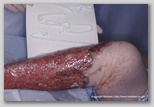 wound image