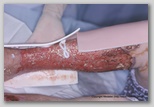 wound image