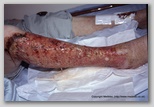 wound image