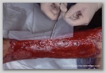 wound image