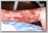 wound image