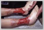 wound image