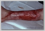 wound image