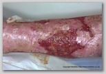 wound image