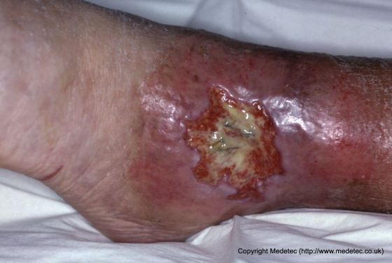 Sloughy leg ulcer