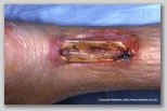 wound image