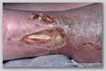 wound image