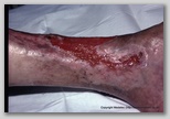 wound image