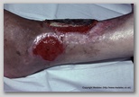 wound image