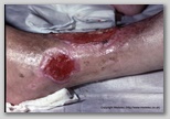 wound image