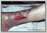 wound image