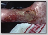 wound image